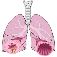 Bronchitis