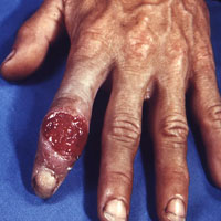 Eosinophilia