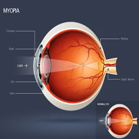 Myopia