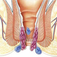 Renal Calculi