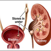 Renal Calculi