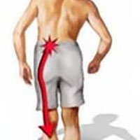 Sciatica Pain