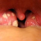 Tonsillitis
