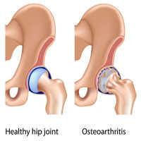 Hip Joint Pain