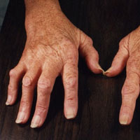 Rheumatism